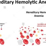 Hemolytic Anemia