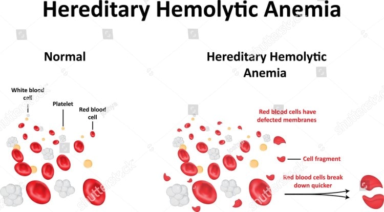 The Many Types of Hemolytic Anemia You must Know About