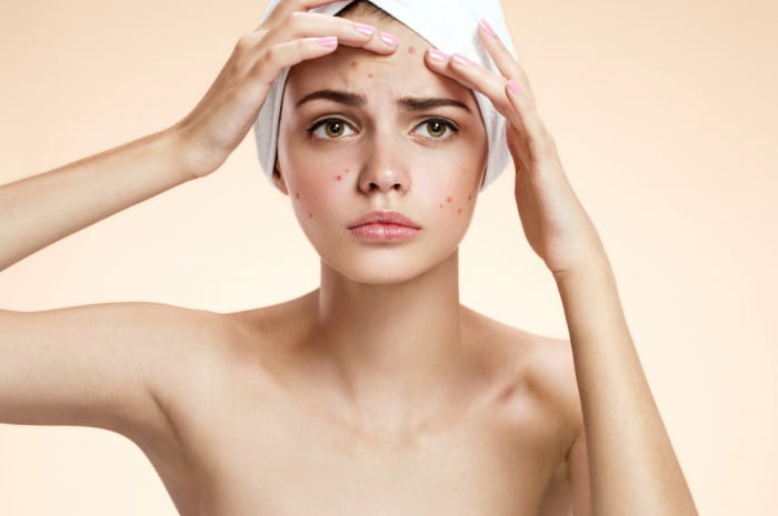 6 Ways to Get Rid of a Pimple Overnight