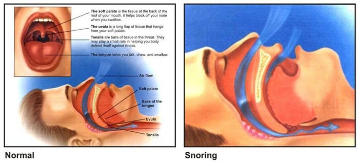 What Causes Snoring