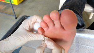 A Not-To-Do List: 8 Ways to Worsen Your Foot Blister