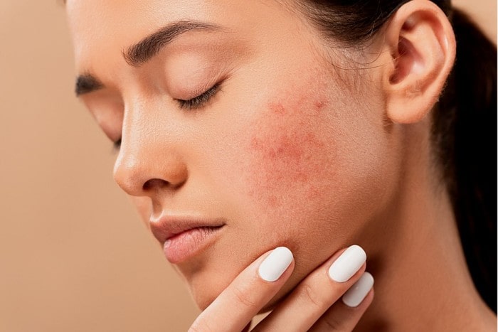 Skin Disorders Related to Various Skin Types