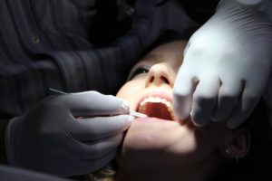 Getting Veneers