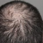 how to stop hair fall immediately