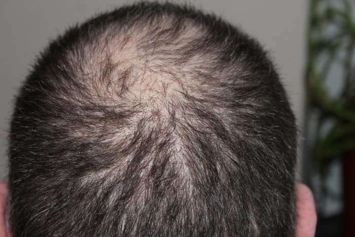 7 Non-Surgical Ways to Deal with Hair Loss