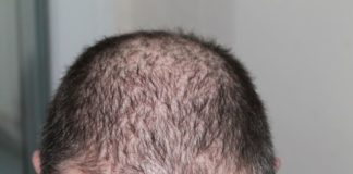 Prevention Of Hair Loss Archives Trionds