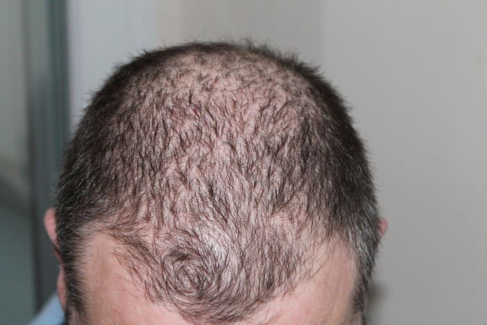 How to Stop Hair Fall and Regrow Hair Naturally?