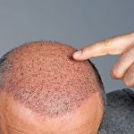 FUE Hair Transplant