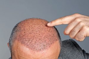 FUE Hair Transplant