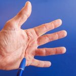 Dupuytrens Contracture