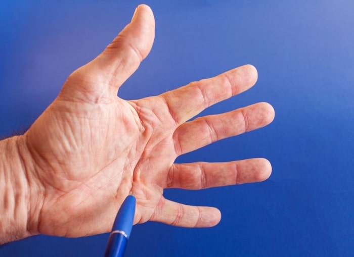 Dupuytren’s Contracture: An Early-Stage Cure that Makes Living Life Easier