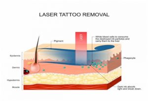 Laser removal