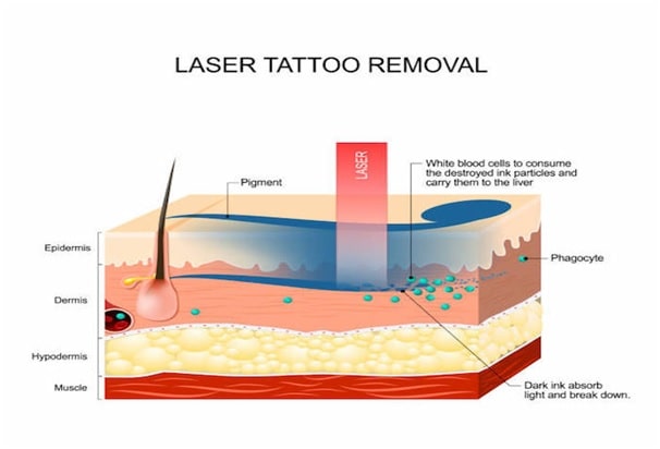 Laser removal