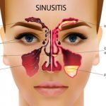 Sinusitis