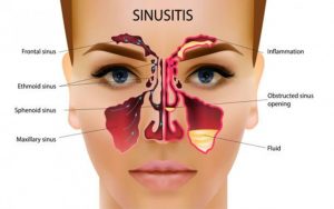 Sinusitis