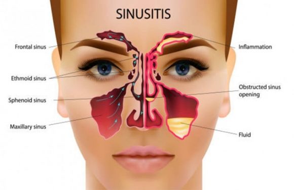 7 Tips to Manage Sinusitis in Small Kids