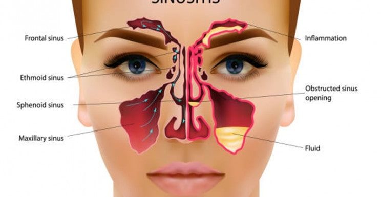 7 Tips to Manage Sinusitis in Small Kids